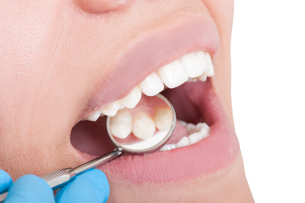 When You May Need A Deep Teeth Cleaning